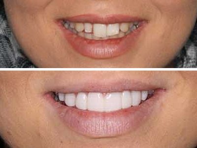 Sydney-Dental-Veneers