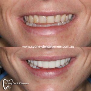 Composite veneers sydney