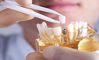 Dental Implant in Sydney