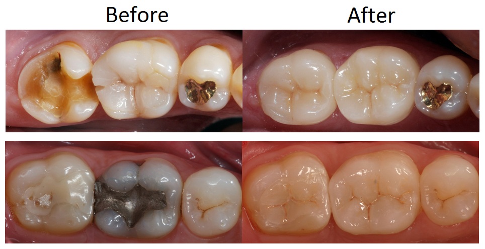 Sydney Dental Vineer