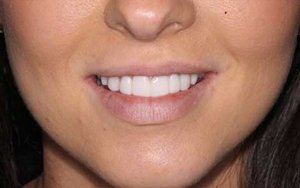 Sydney Dental Veneer