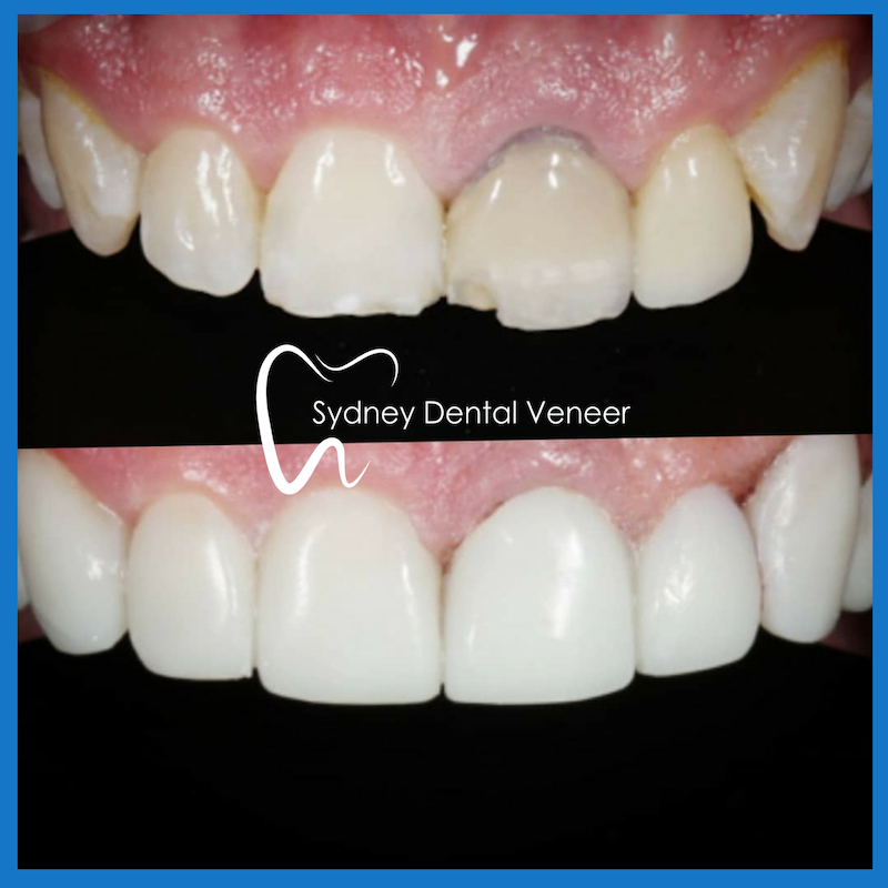 Best dental veneers in Sydney