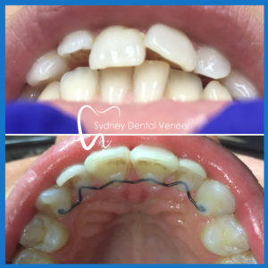 Invisalign in Sydney