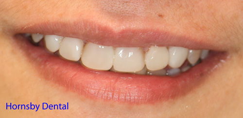 Case02-After Sydney Dental Veneers