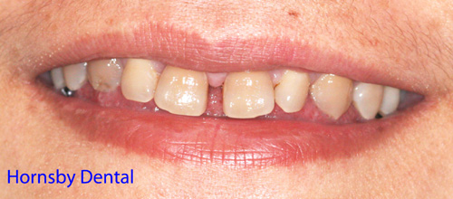 Case02-Before Sydney Dental Veneers