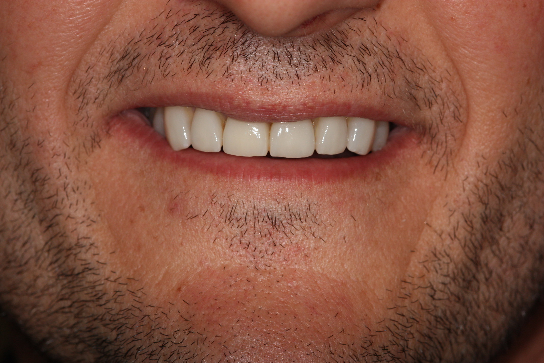 Case03-After Sydney Dental Veneers