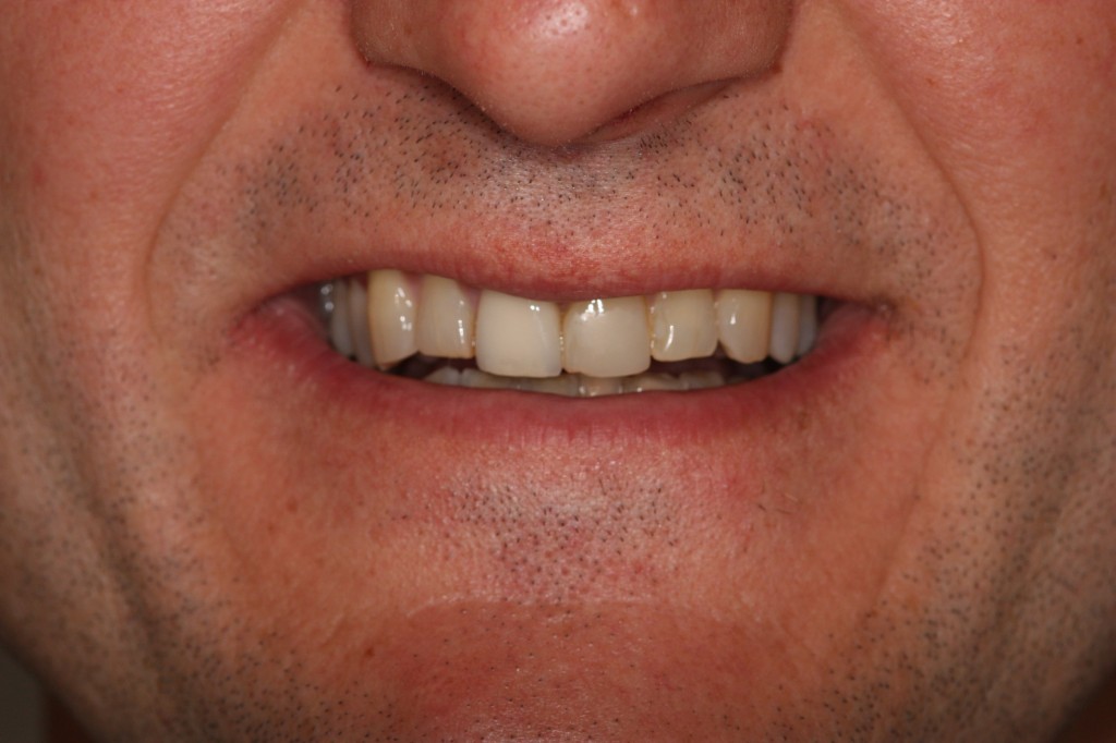 Case03-Before Sydney Dental Veneers