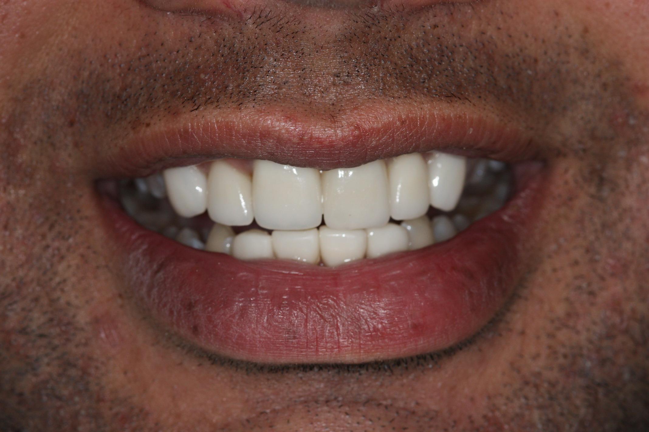 Case04-After Sydney Dental Veneers