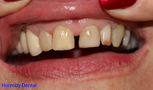 Case01-Before Sydney Dental Veneers