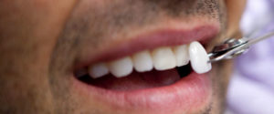 We have the best dental veneers in Sydney.