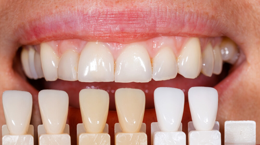We are the best dentistry for porcelain veneers.