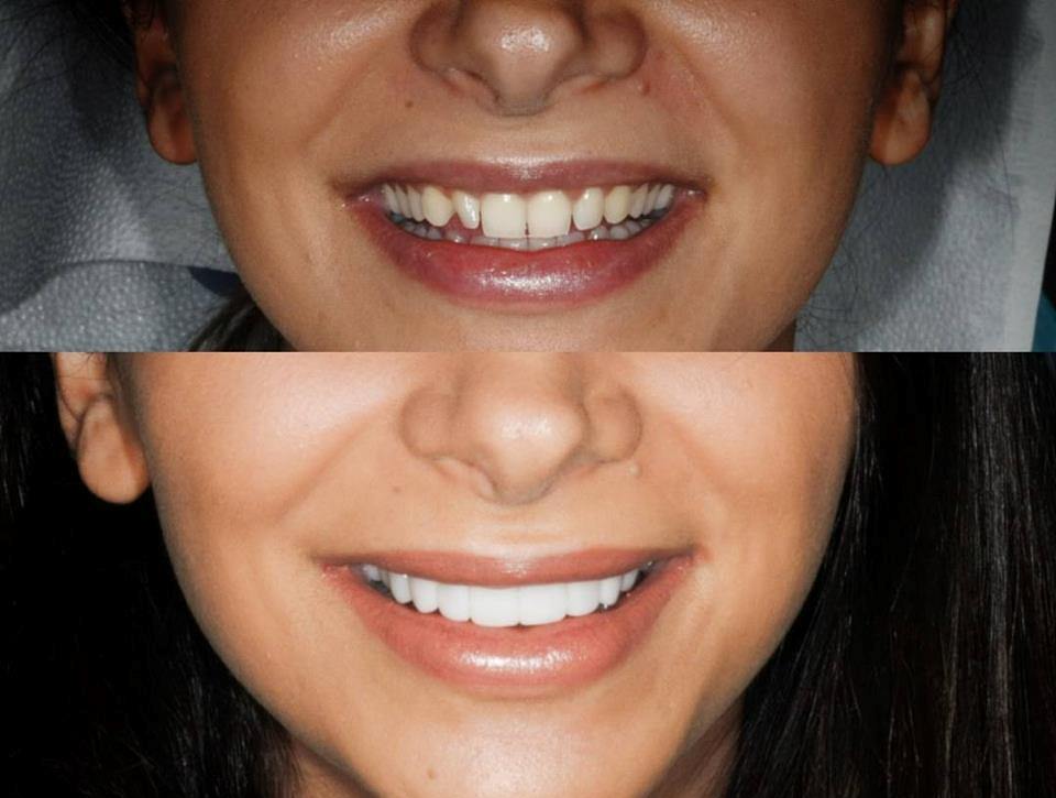 What an awesome smile transformation!