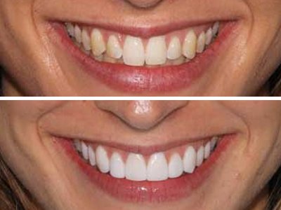 Pretty smile transformation by our client.