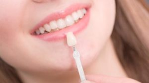 Porcelain Veneers Cost in Sydney