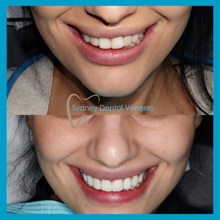 Veneers Before And After Sydney Dental Veneers