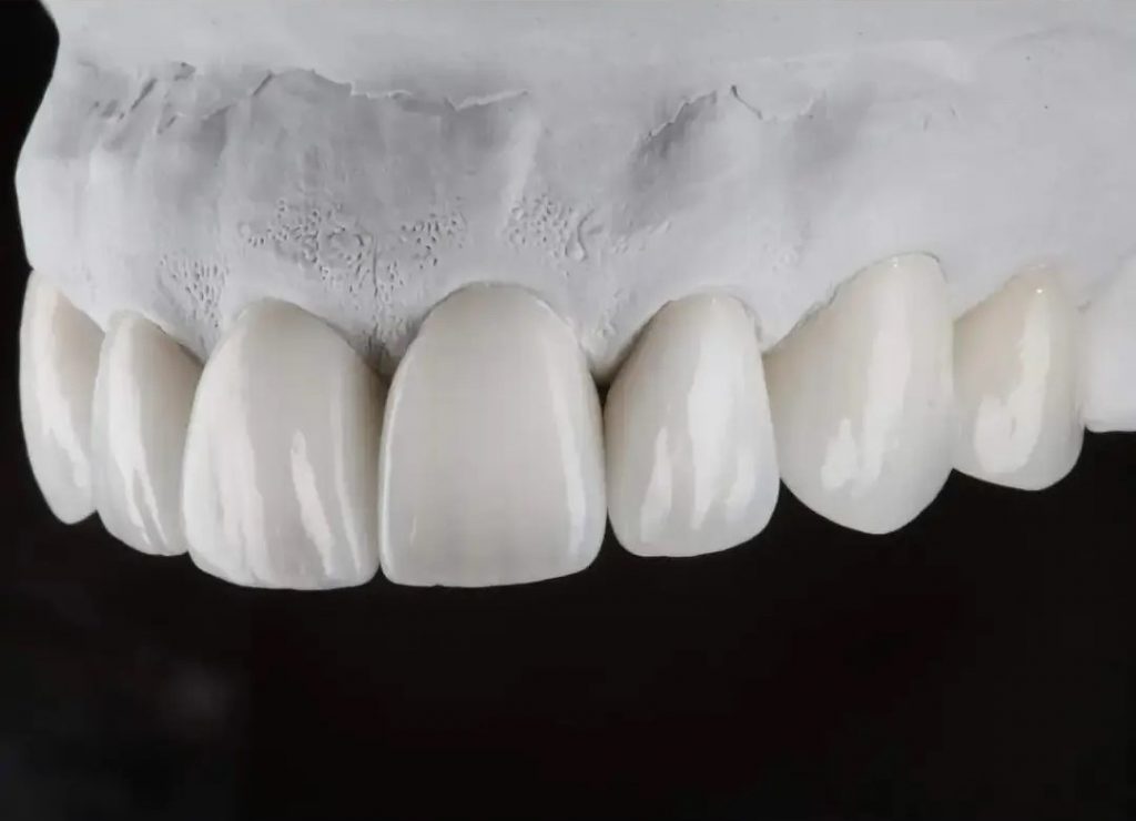 Porcelain Veneers Sydney