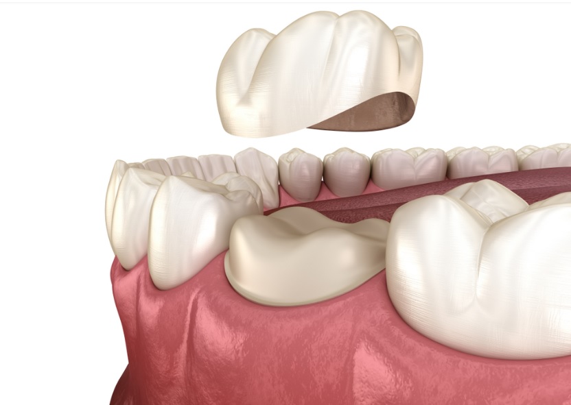 Crowns Teeth