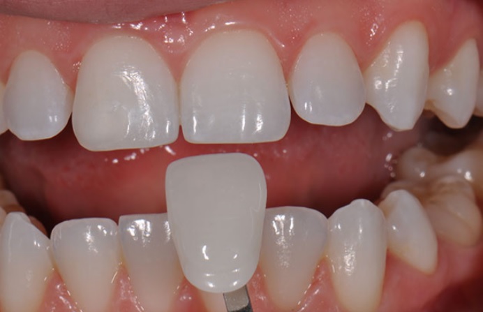 Dental Veneers Sydney