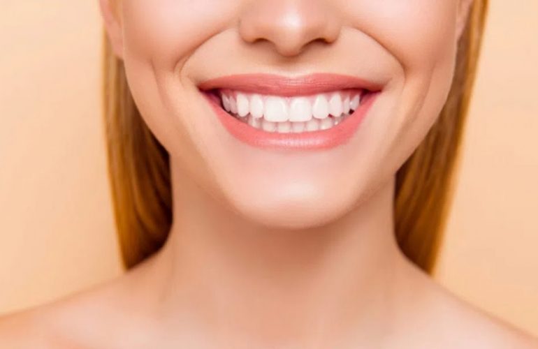 Dental Veneers Cost