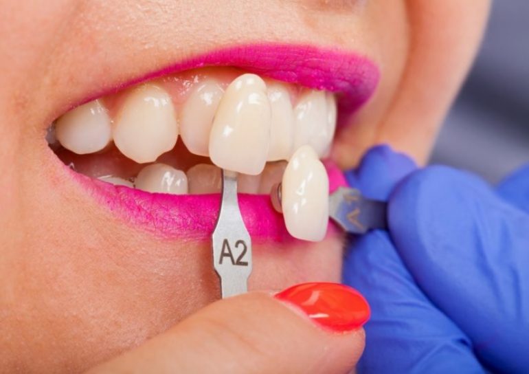 How Much Do Veneers Cost? Sydney Dental Veneers