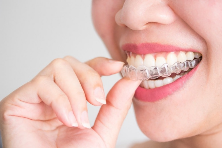 How Much is Invisalign? Sydney Dental Veneers