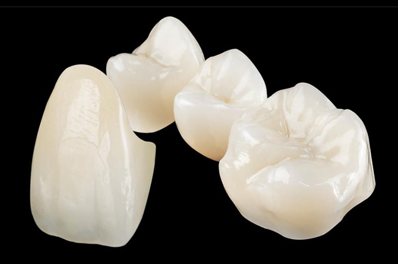 Tooth Crown Cost