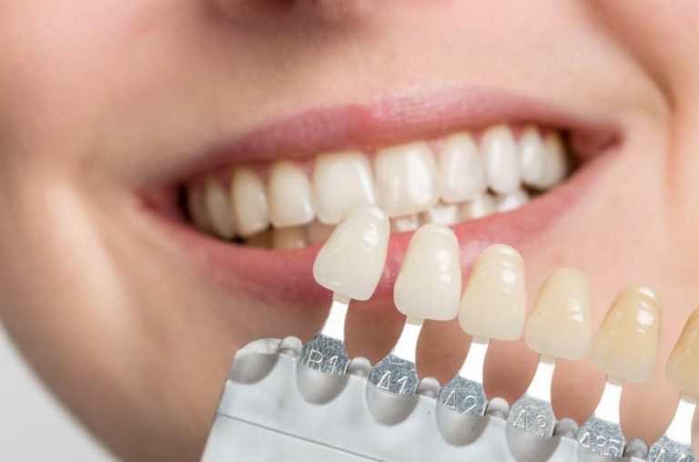 Veneers Price Cost of Veneers Sydney Dental Veneers