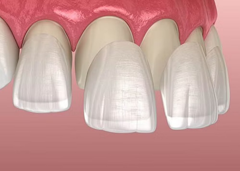 What are Porcelain Veneers