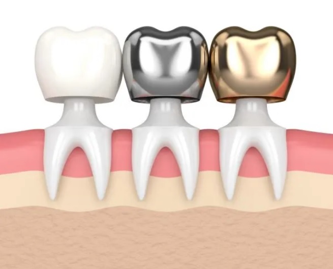 why-would-you-need-a-dental-crown-vitafoodssouthamerica