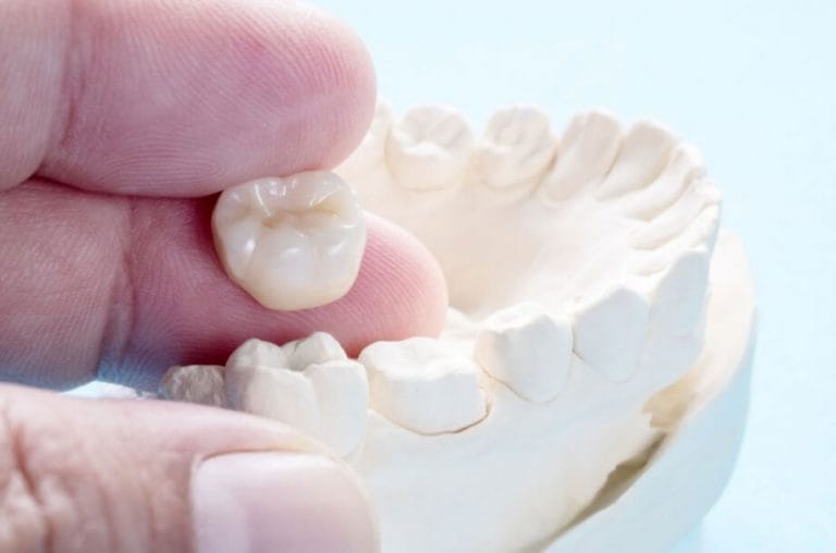 Tooth Crown | Sydney Dental Veneers