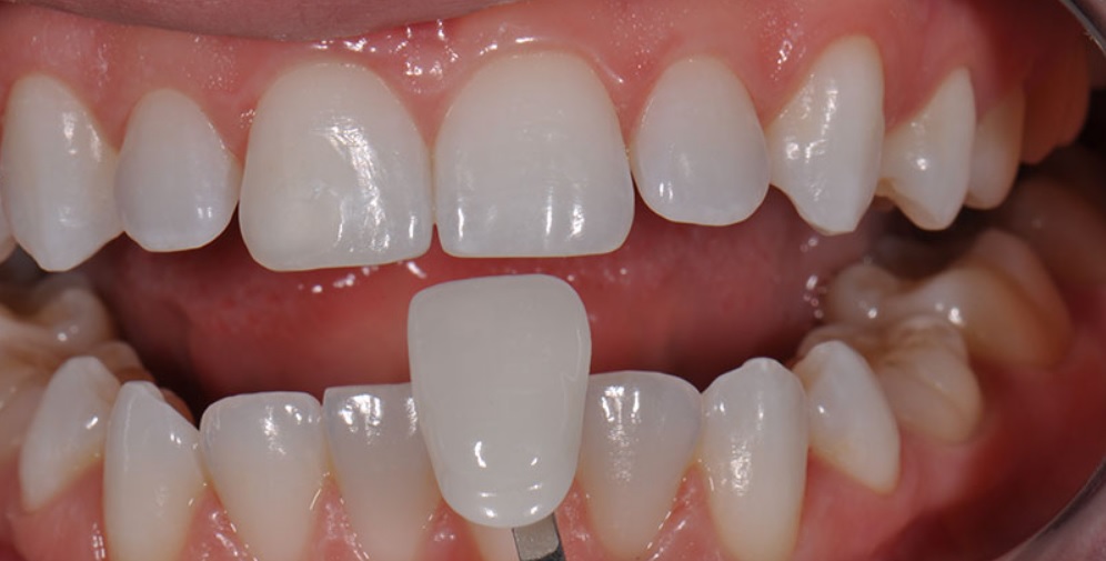 Veneers Teeth