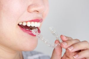 Invisalign Price