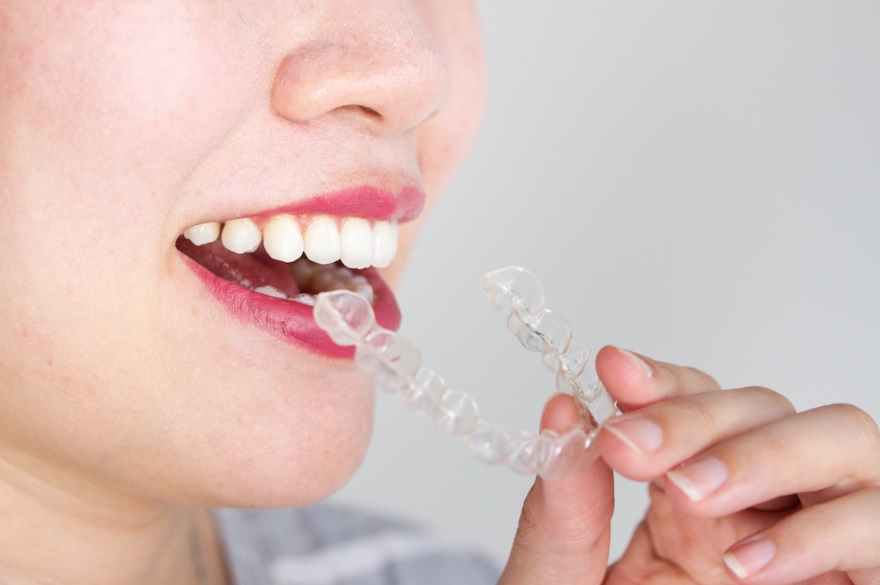 Invisalign Price Invisalign Cost Sydney Dental Veneers