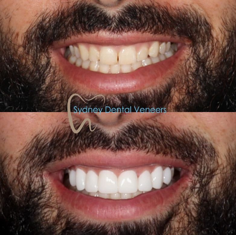 Porcelain Veneers Sydney