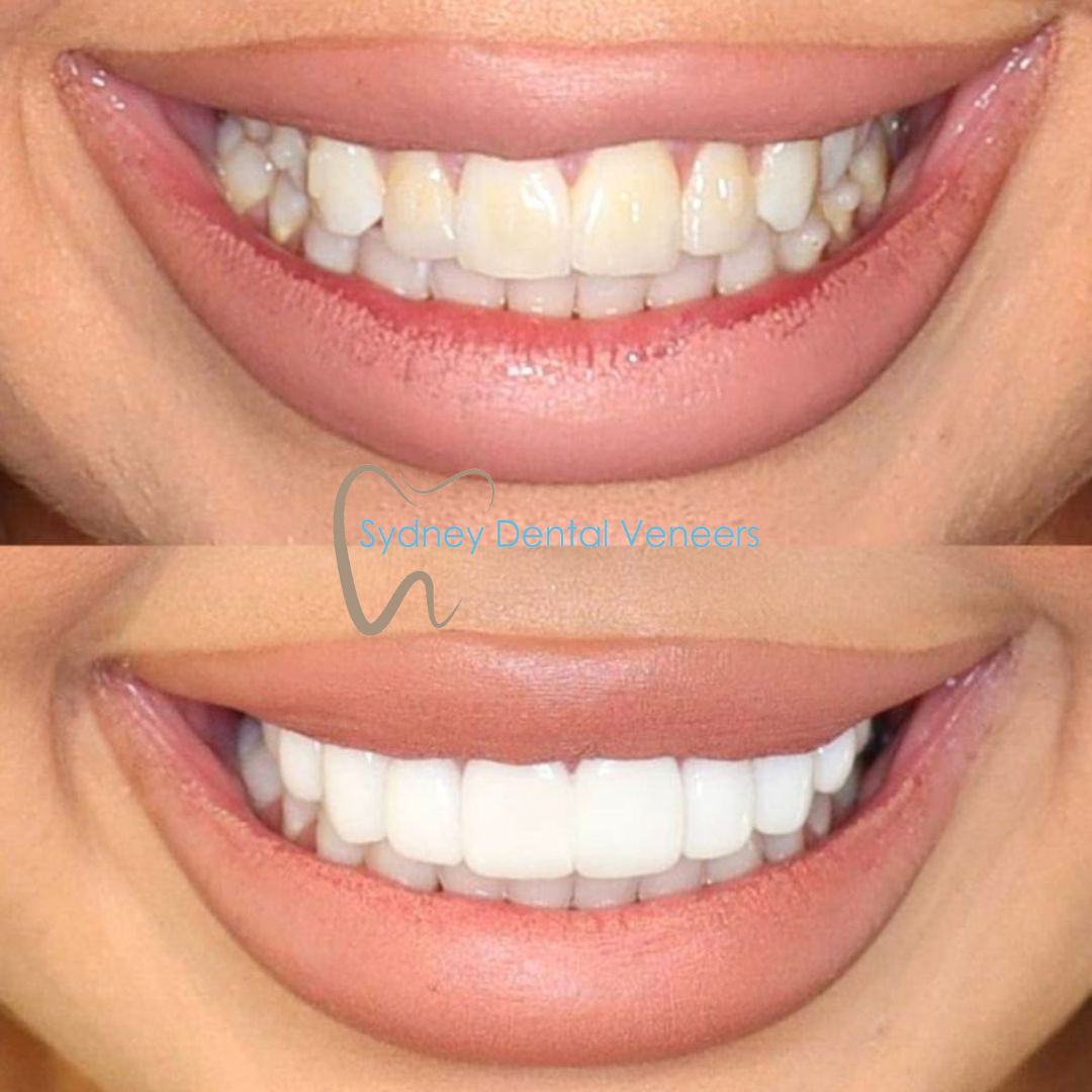 Porcelain Veneers Sydney