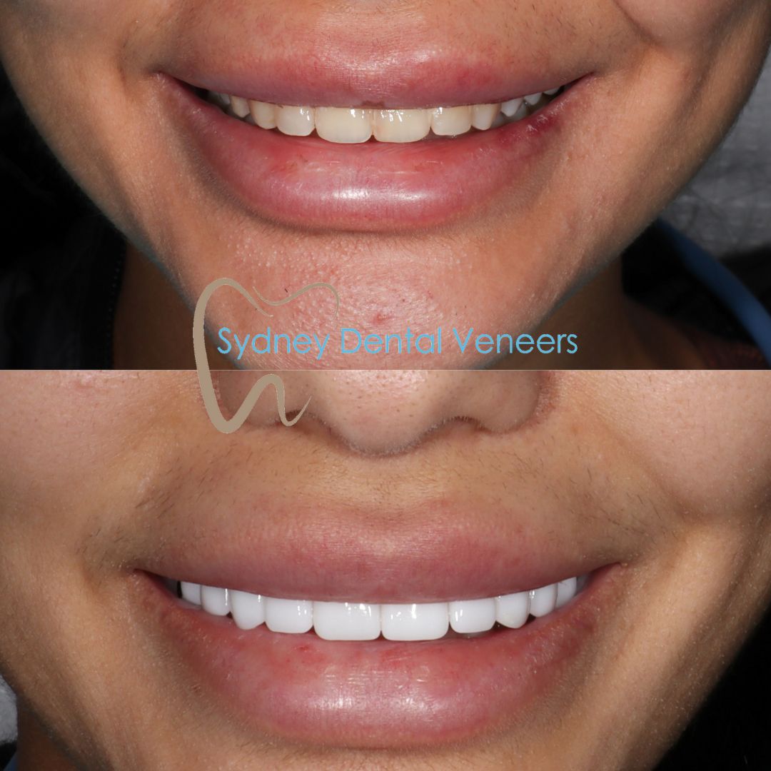 Porcelain Veneers Sydney