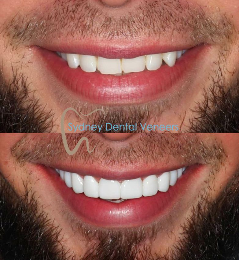 Porcelain Veneers Sydney