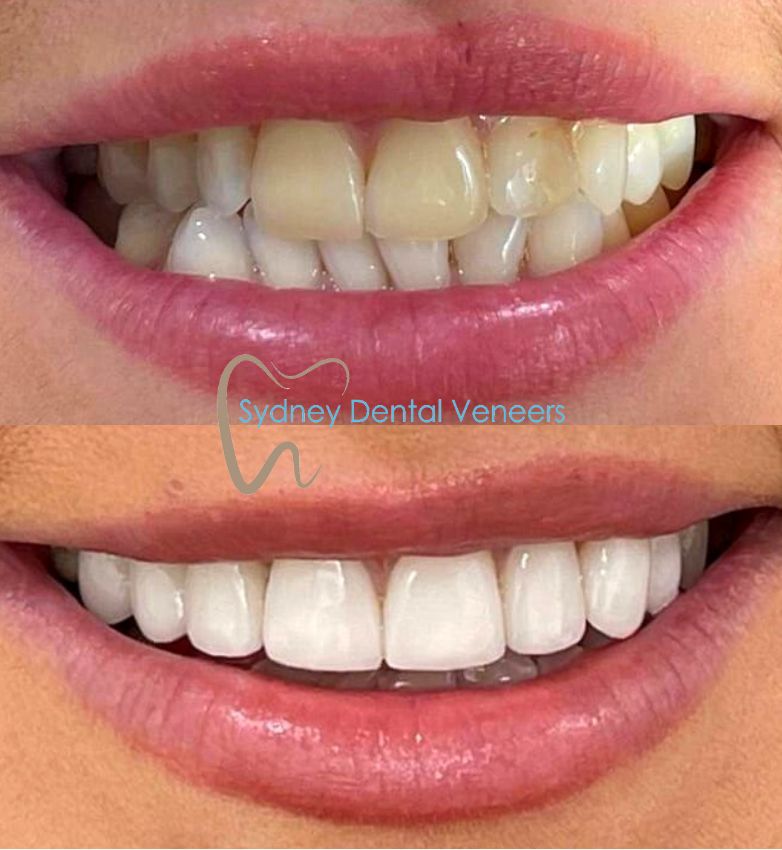 Porcelain Veneers Sydney