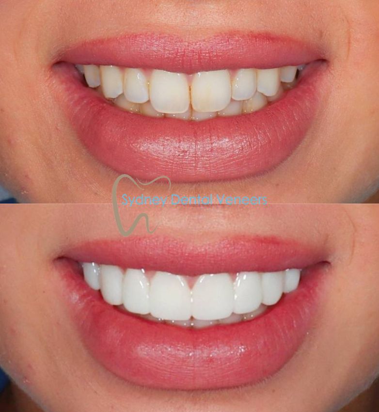 Porcelain Veneers Sydney