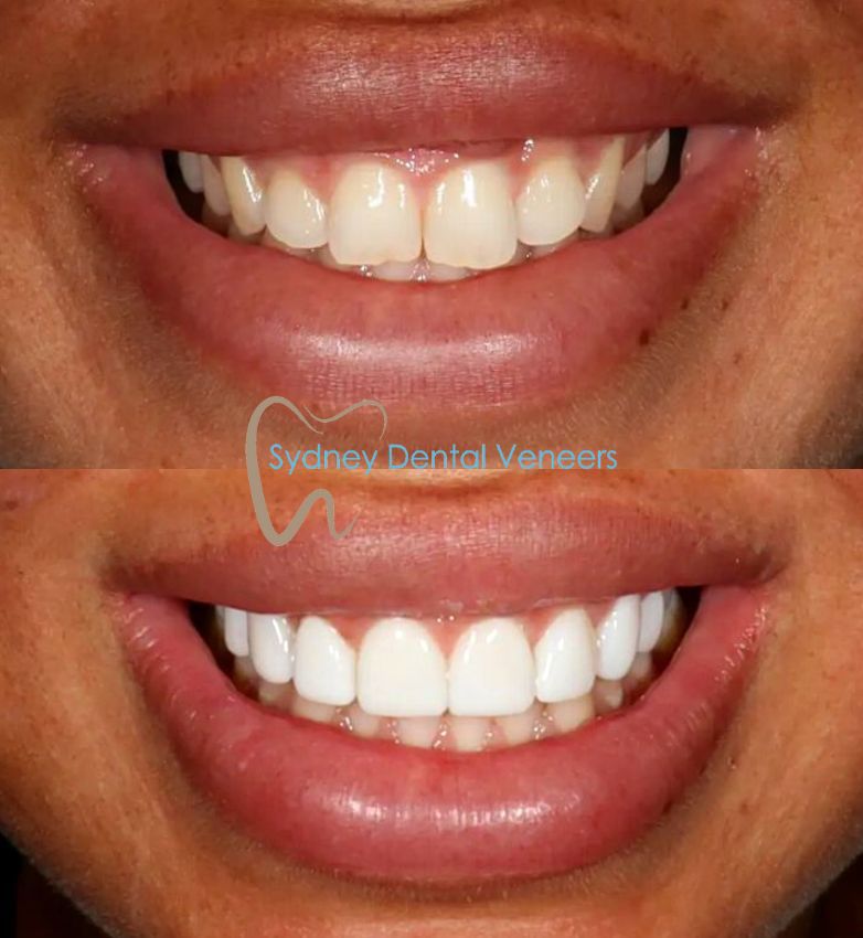 Porcelain Veneers Sydney