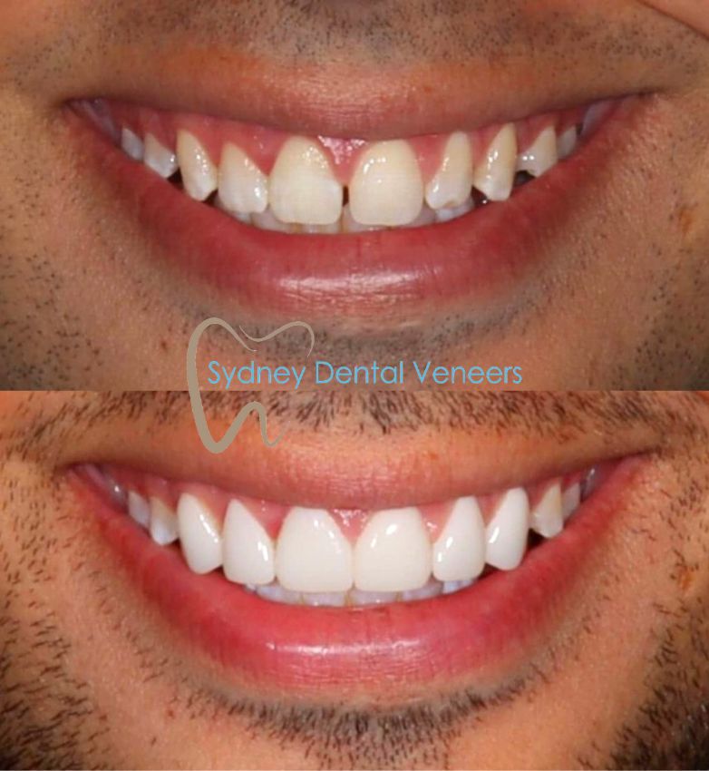 Porcelain Veneers Sydney