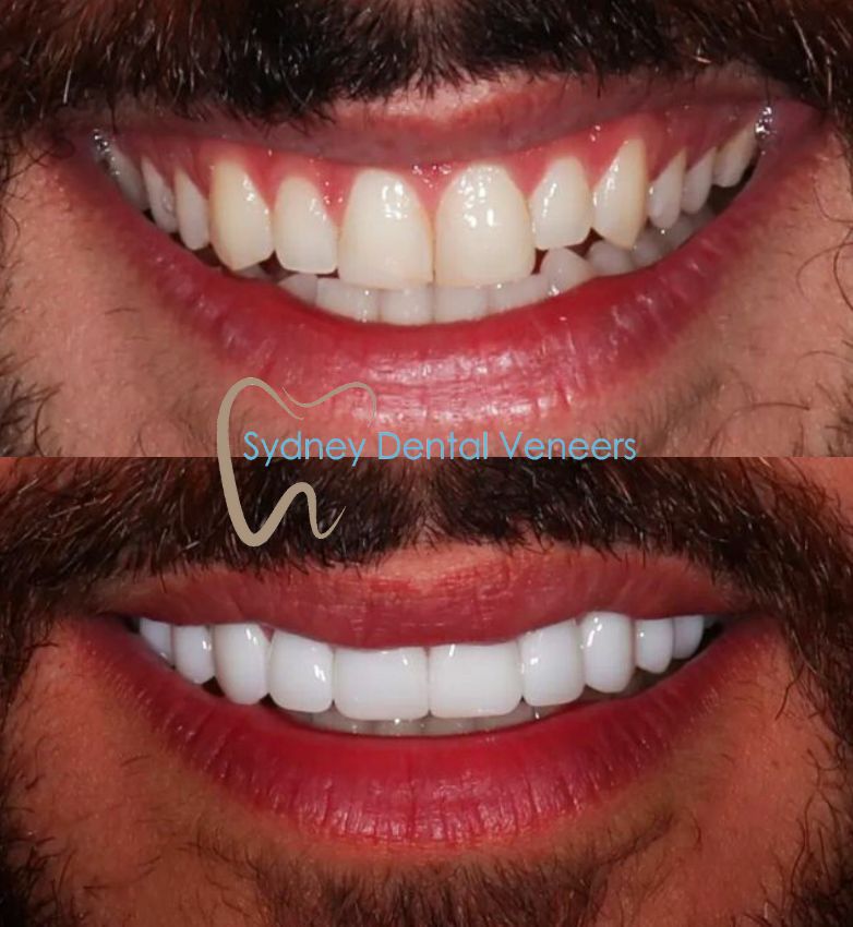 Porcelain Veneers Sydney