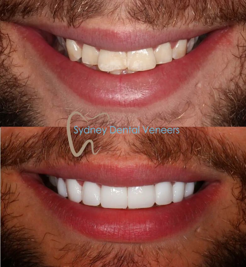 Porcelain Veneers Sydney