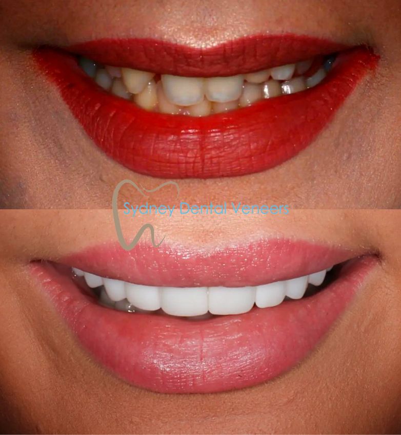 Porcelain Veneers Sydney