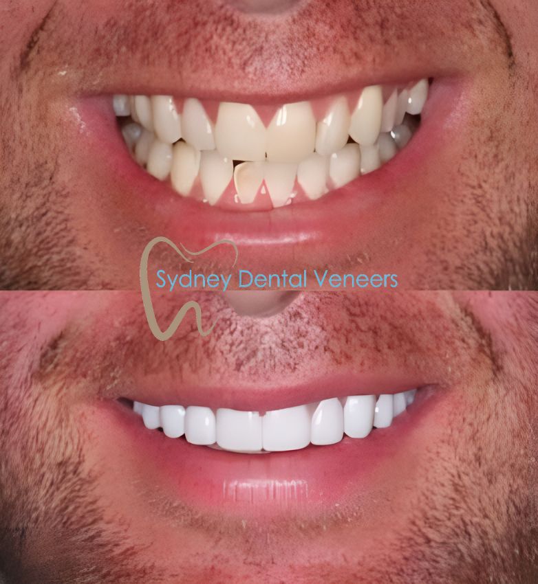 Porcelain Veneers Sydney