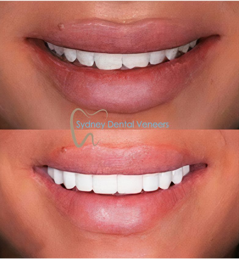 Porcelain Veneers Sydney