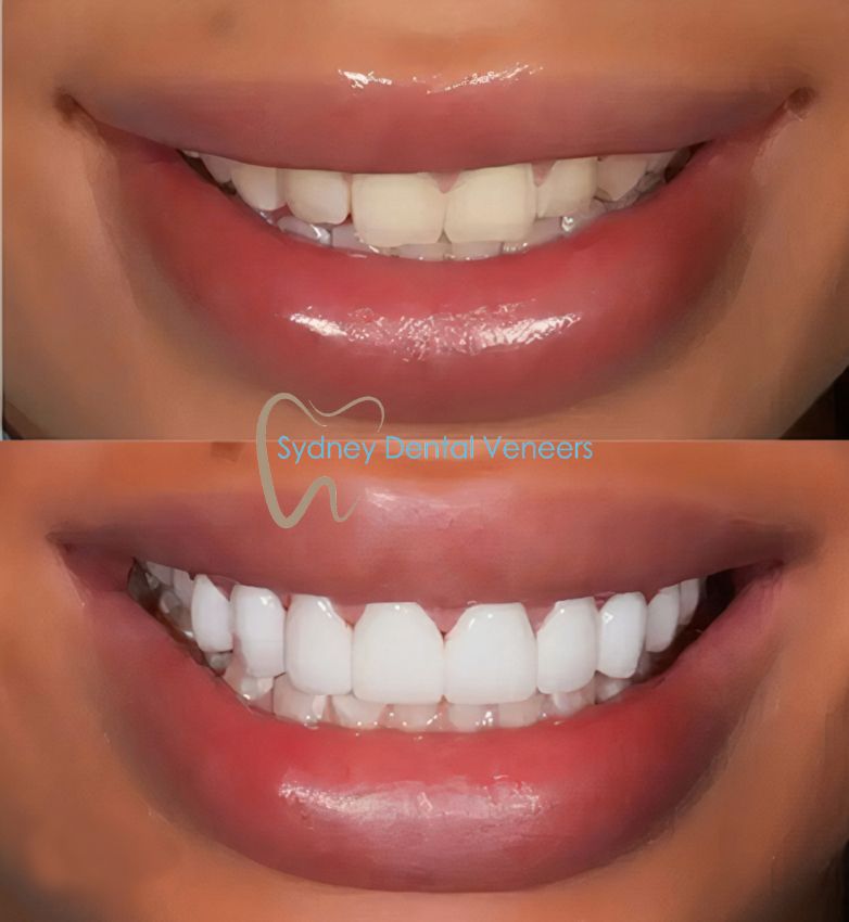 Porcelain Veneers Sydney