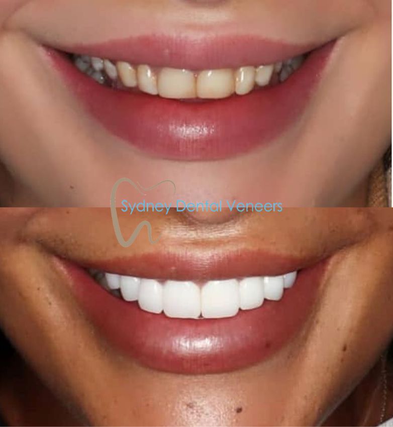 Porcelain Veneers Sydney