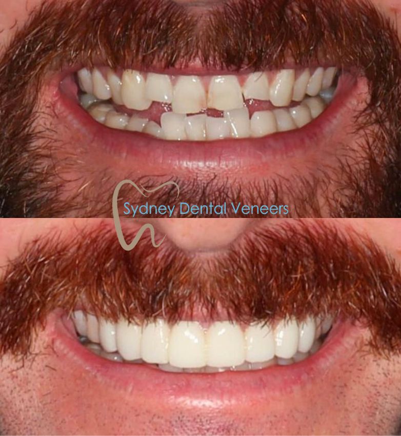 Porcelain Veneers Sydney