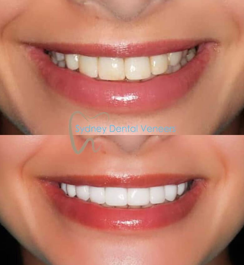 Porcelain Veneers Sydney